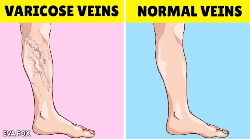 5 home remedies you can use to remove varicose veins in your legs